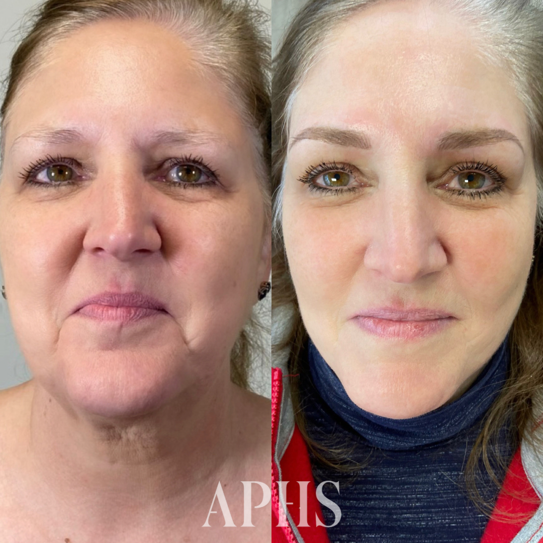 Thin or Mature Skin and Microblading