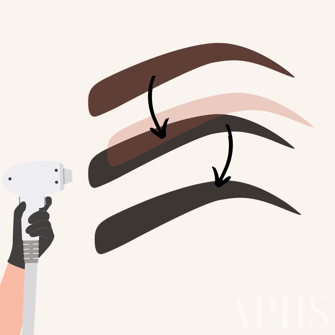 Dark Brows After Laser Removal