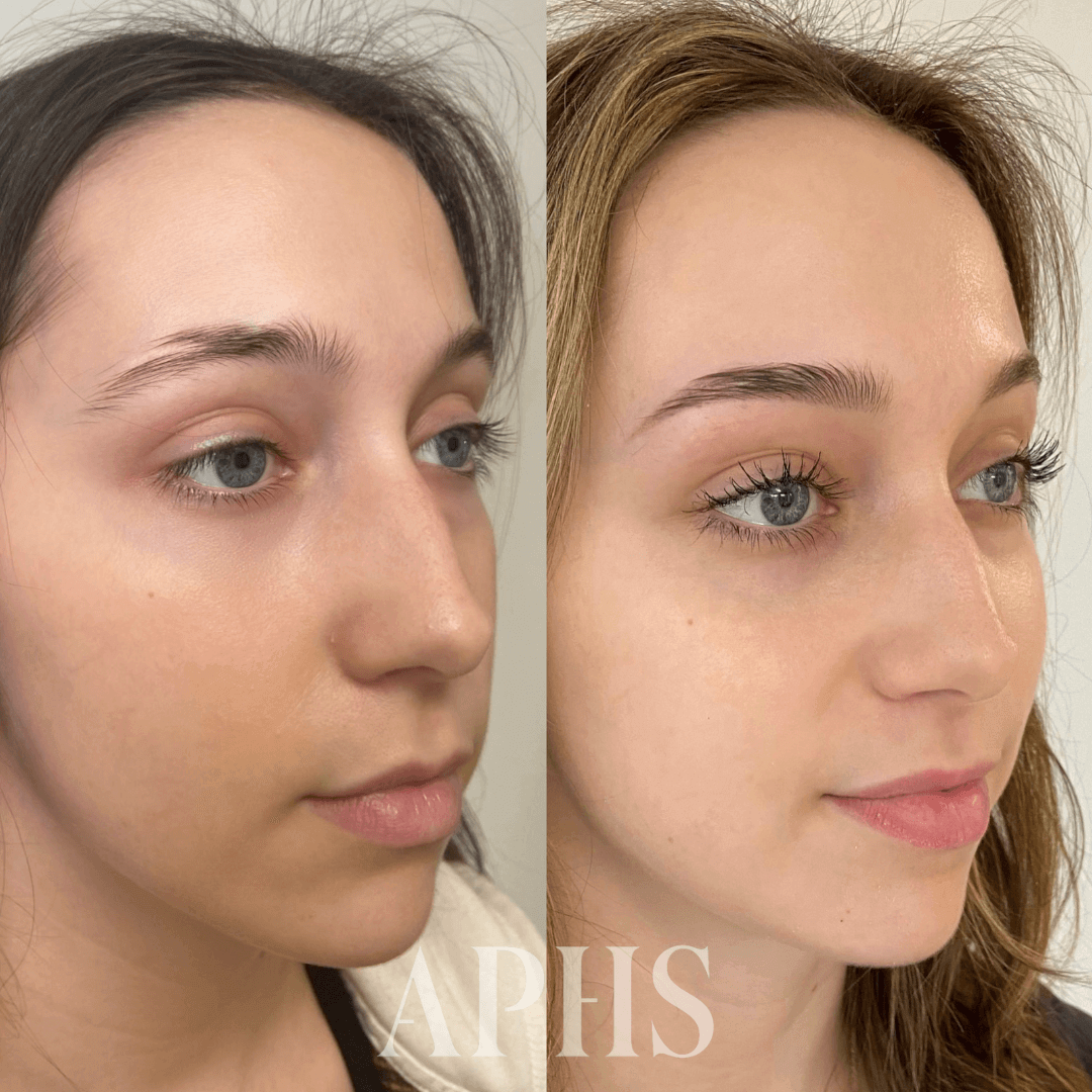 Before and after of a woman with a scar through her eyebrow, camouflaged using the ombre method.